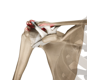 Physical Therapy in Fremont, Carbon, and Sweetwater Counties for  Osteoarthritis Acromioclavicular