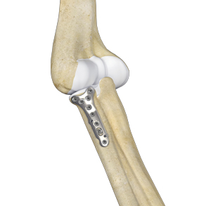 cpt code for orif radial head fracture