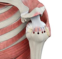 Arthroscopic Rotator Cuff Repair and Bicep Tenodesis: Right